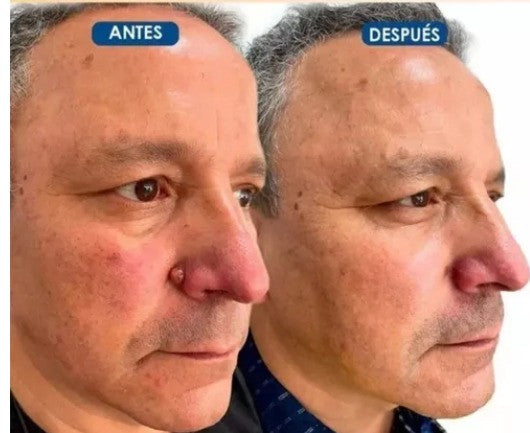 2X1/ FormuClear™ - Elimina verrugas sin dolor y seguro + ENVIO GRATIS