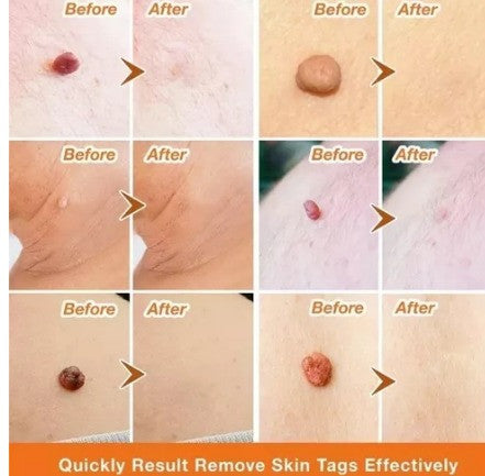 2X1/ FormuClear™ - Elimina verrugas sin dolor y seguro + ENVIO GRATIS