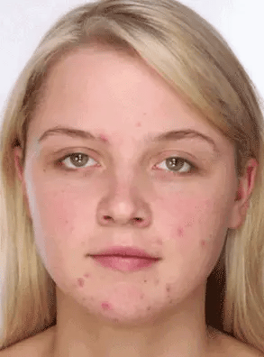 El Eliminador de Acné Definitivo