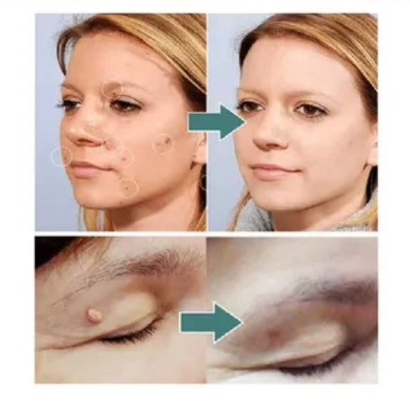 2X1/ FormuClear™ - Elimina verrugas sin dolor y seguro + ENVIO GRATIS